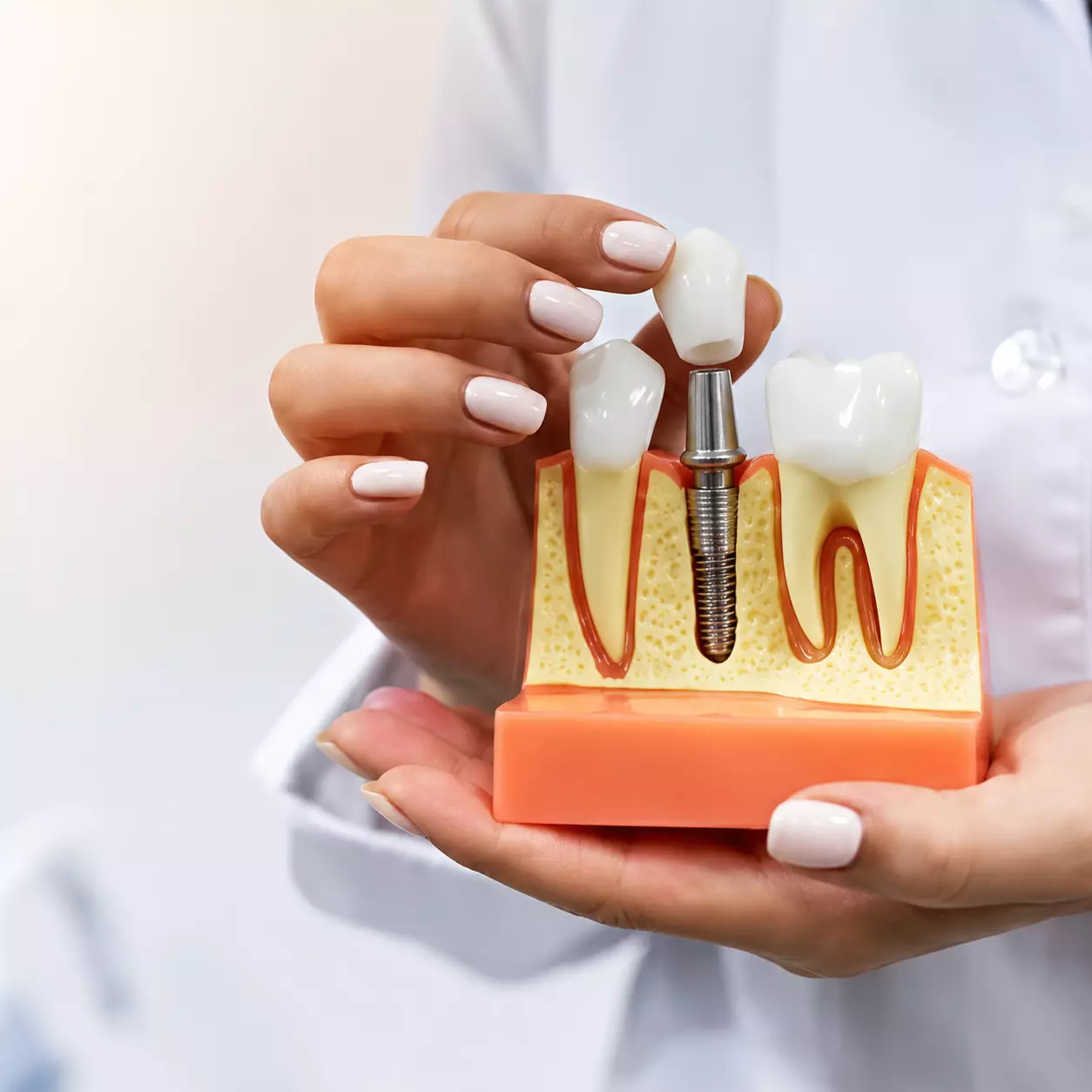 Dental Implants