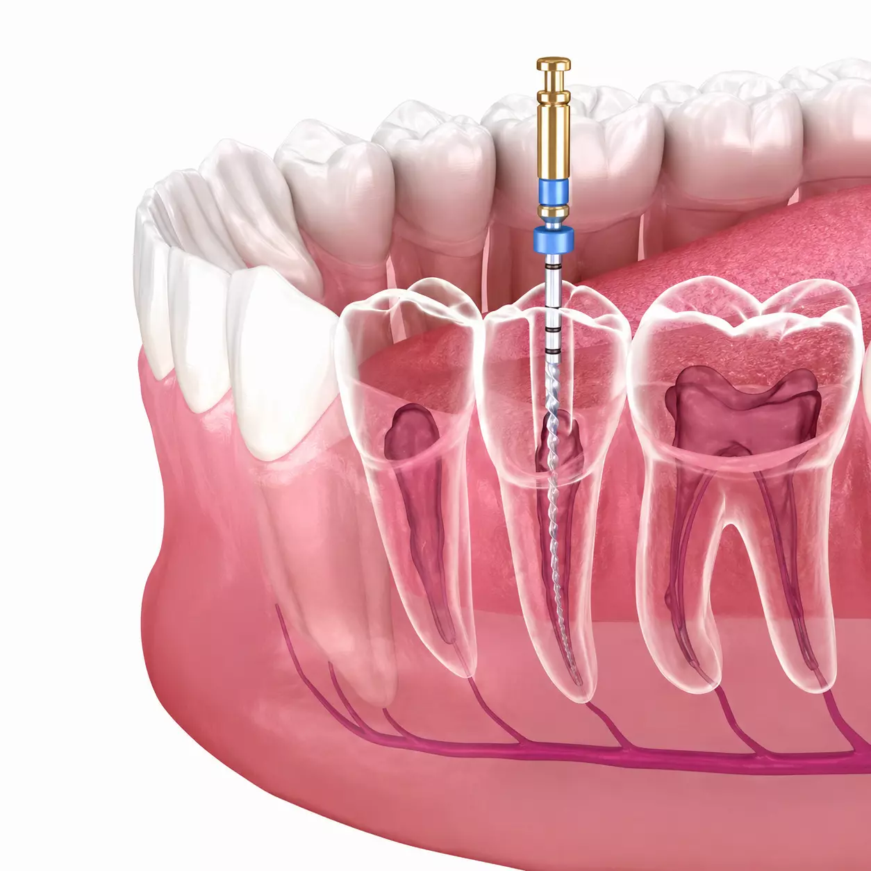 Root Canal Treatment