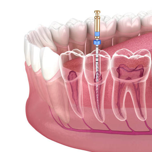 Endodontic root canal treatment process. Medically accurate tooth 3D illustration.